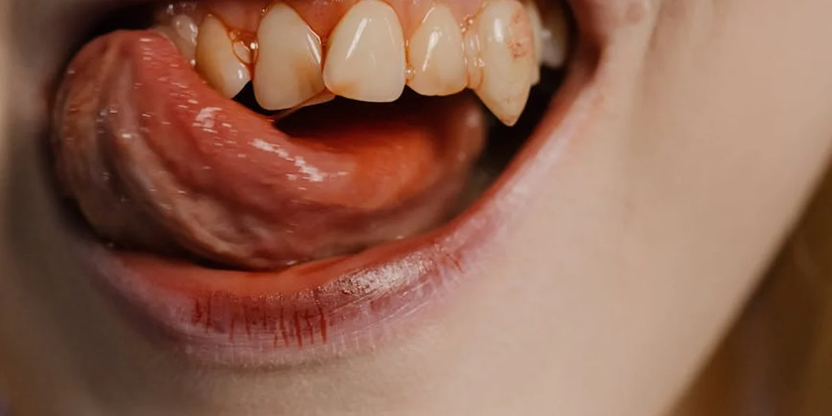 Close-up of a mouth with teeth and a little blood on the lips, suggesting a dog bite.
