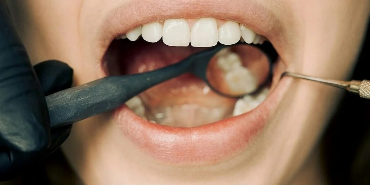 Close-up of an open mouth with dental tools (mirror and tweezers) in use, symbolizing anxiety about tooth loss
